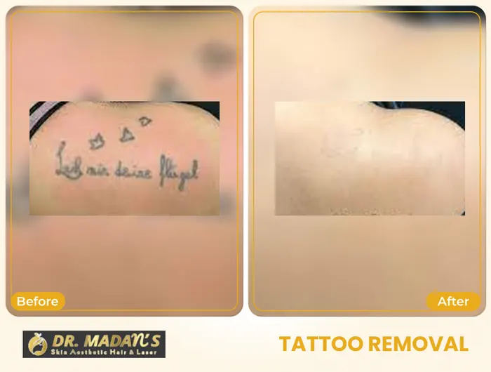 Tattoo removal before and after result 14 at Dr Madan Aesthetics